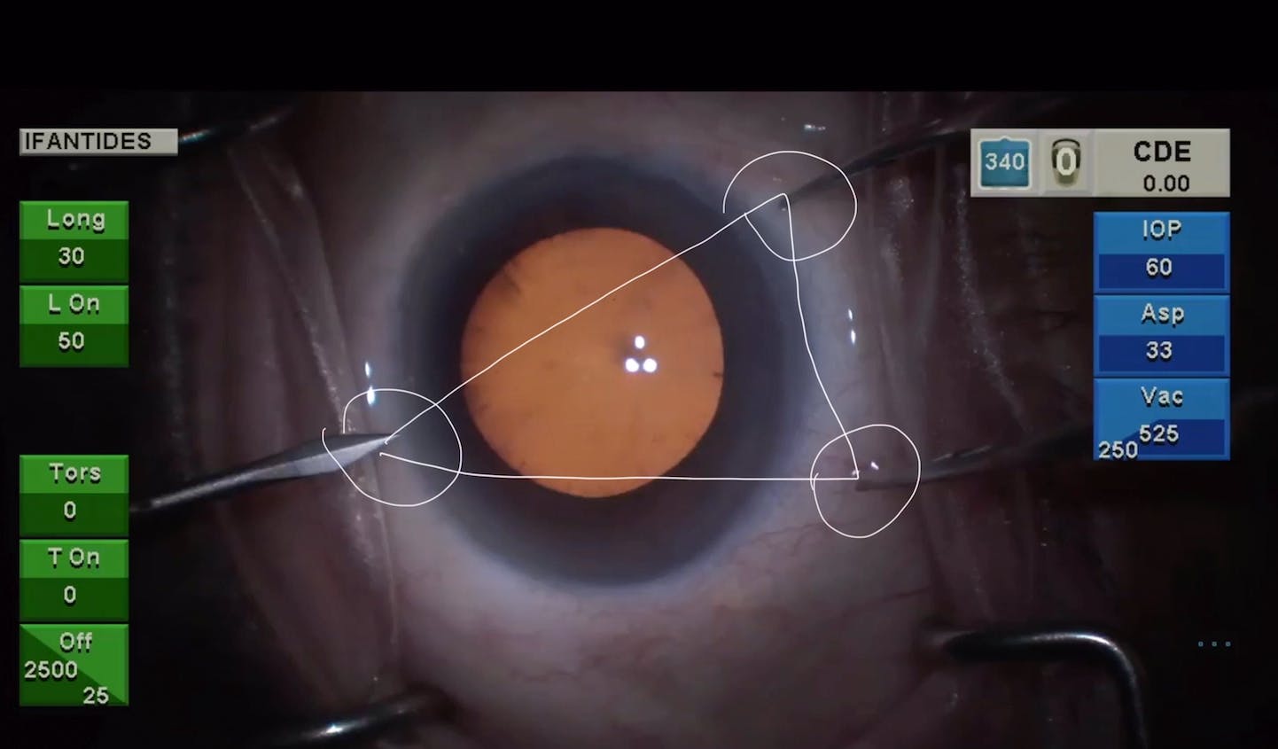 BreadandButter Cataract Surgery Eyetube